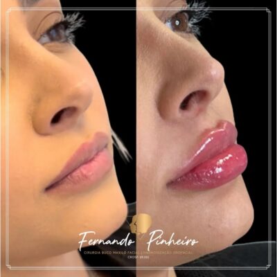 Harmonização Orofacial