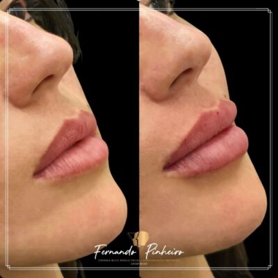 Harmonização Orofacial