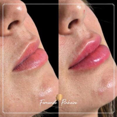 Harmonização Orofacial